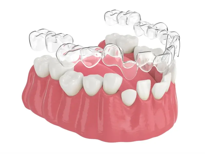 Ile kosztuje Invisalign w Polsce?