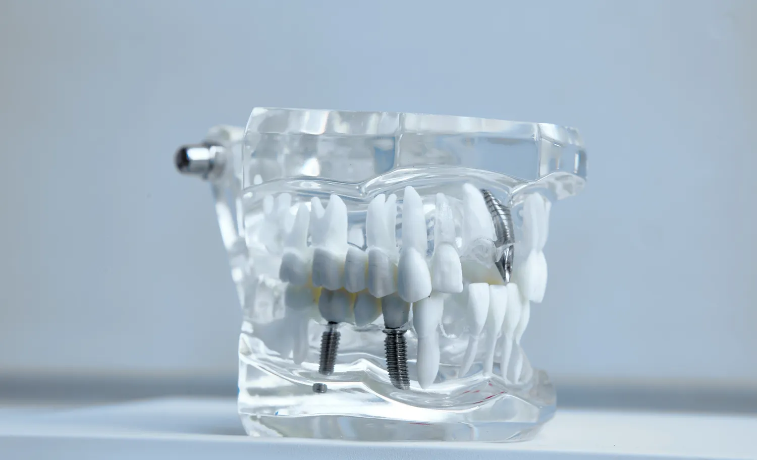 Co trzeba wiedzieć o implantach zębowych?